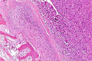 Management of postmenopausal osteoporosis
