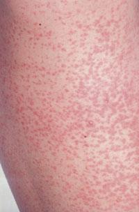 Management of rubella infection in pregnant women