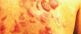 Management options of AIDS-related Kaposi sarcoma