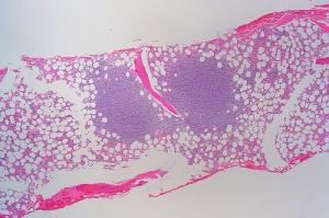 Mantle cell lymphoma - an indolent or an aggressive disease?