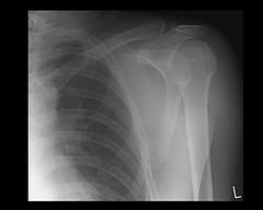 Manual therapy for frozen shoulder