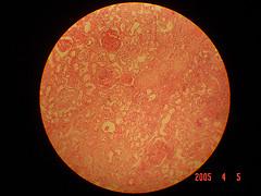 Medical treatment for acute glomerulonephritis