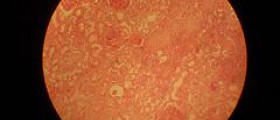 Medical treatment for acute glomerulonephritis