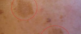 Melasma natural treatment