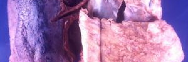 Mesothelioma cancer treatment