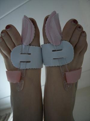 Minimally invasive surgery for bunions