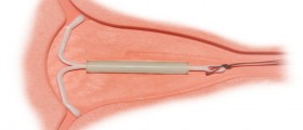 Intrauterine Devices: A Contraceptive Option More Women Should Consider