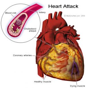 Misdiagnosed heart attack