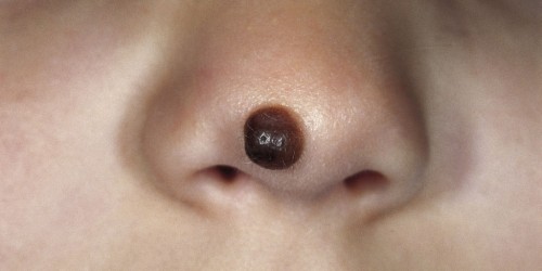 Moles: When To Be Worried