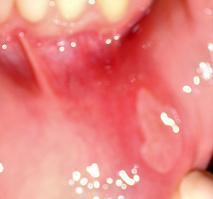 Mouth problems - Non injury