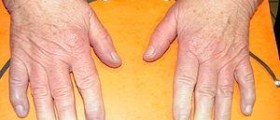 Multiple system atrophy (MSA) - Degenerative neurological disorder