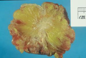 Mystery of breast cancer