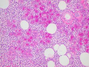 Natural cure for lymphoma