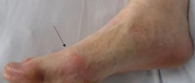 Natural cures gout - stop taking pain killers and finally treat gout