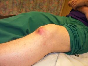Natural gout treatment – alkaline water as a natural gout remedy