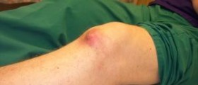 Natural gout treatment – alkaline water as a natural gout remedy