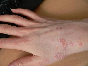 Natural treatment for scabies