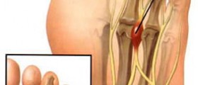 Morton's Neuroma: Symptoms & Treatment