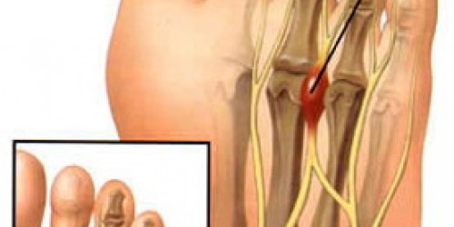 Morton's Neuroma: Symptoms & Treatment