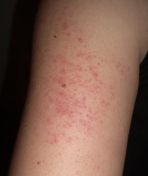 New treatment for keratosis pilaris