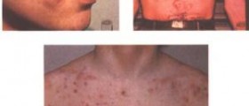 Nodular acne facts