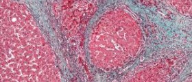 Nutrition therapy for cirrhosis