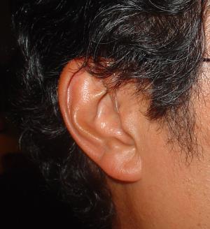 Open ear hearing aids