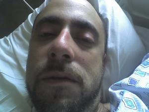 Opioids side effects