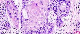 Oral Cancer - Early detection and treatment provide a better chance for cure