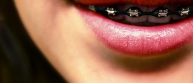 Orthodontic Braces: Common (And Less Common) Questions Answered