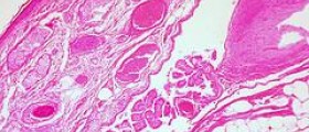 Ovarian cyst medications do not work in the long run