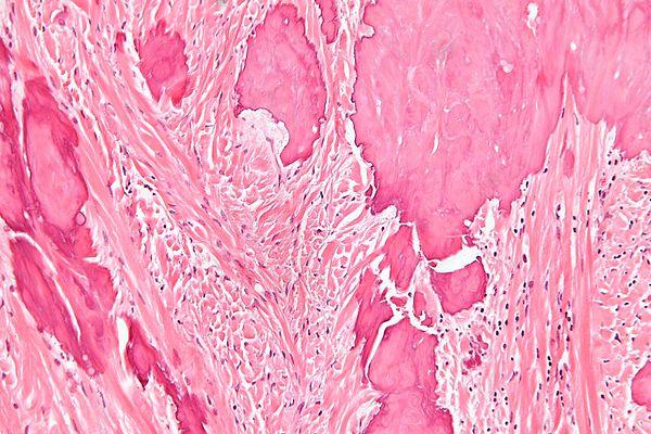 Ovarian cysts and pcos link revealed