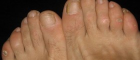 Don't Suffer With Painful Ugly Corns On Your Feet