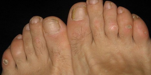 Don't Suffer With Painful Ugly Corns On Your Feet