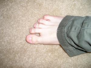 Painful big toe joint
