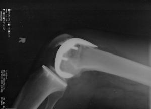 Painful hot knee