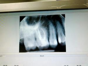 Painful root canal