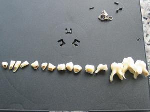 Painful teeth problem