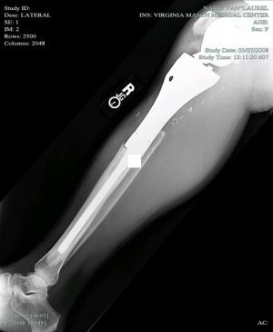 Painful tibia bone