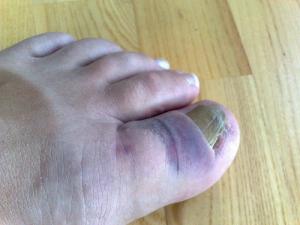 Painful toenail