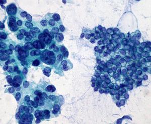 Pancreatic cancer surgery