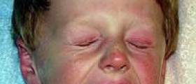 Parents should teach kids about drug allergies!