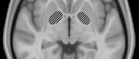 Parkinson's disease and pallidotomy procedure