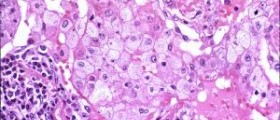 Pathophysiology of pneumonia