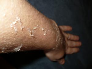 Peeling sunburn skin