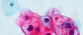 Penile cancer caused by HPV