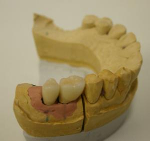 Periodontal gum disease - can you turn it around?