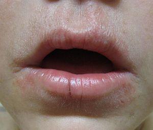 Perioral dermatitis cure