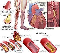 Peripheral arterial disease guidelines