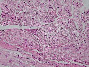 Peripheral arterial disease treatment